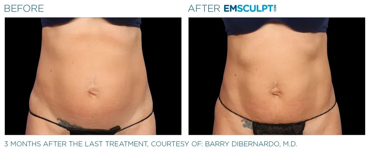 Female abdomen before and after Emsculpt Neo — courtesy of Barry DiBernardo, M.D.