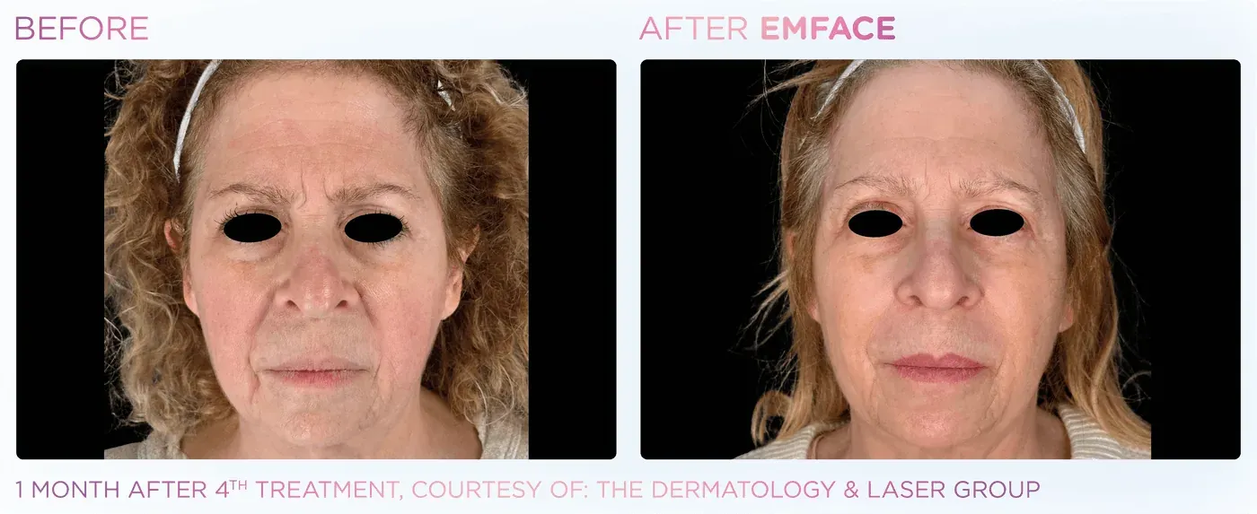 Female full-face before and after EMFACE