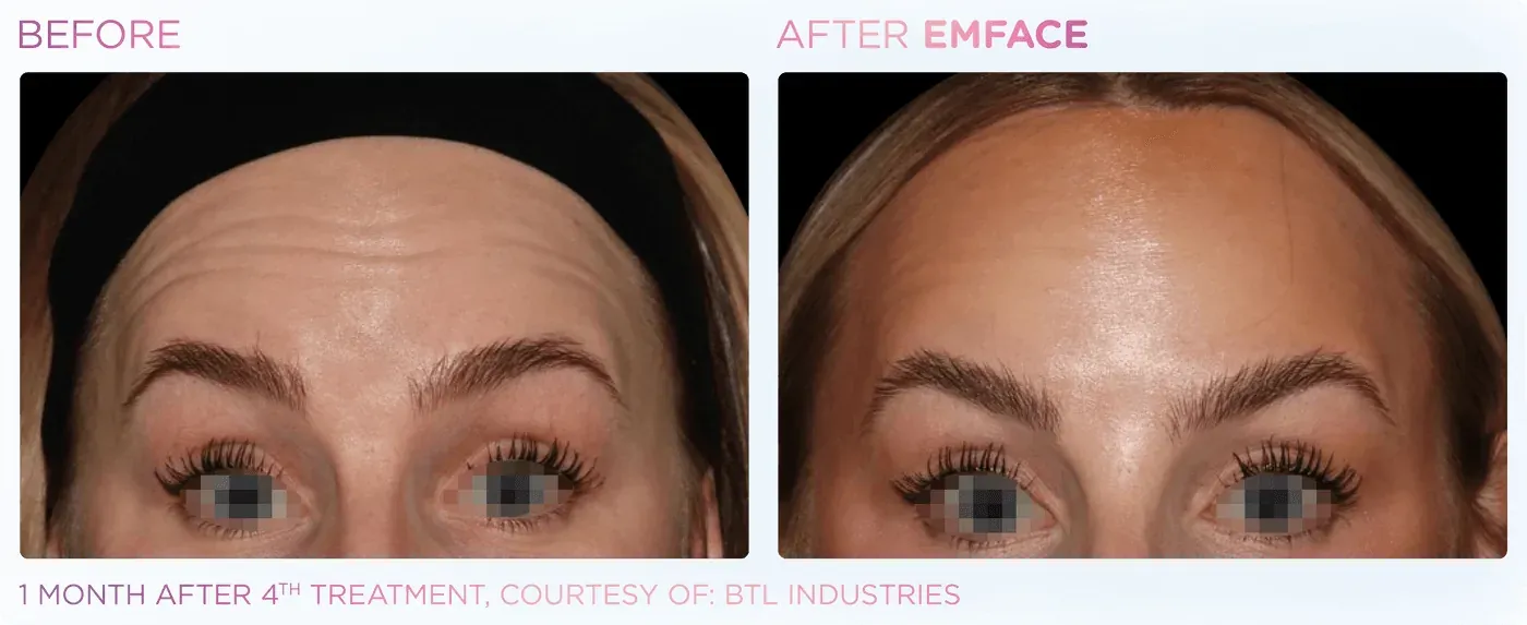 Female forehead before and after EMFACE