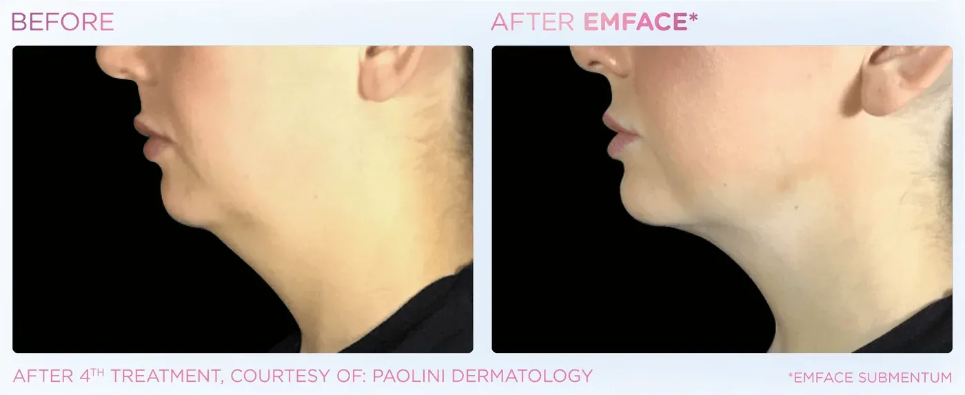 Female submental before and after EMFACE