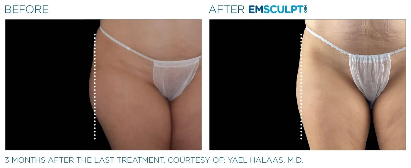 Female outer thighs before and after Emsculpt Neo