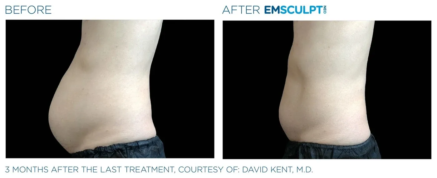 Male abdomen before and after Emsculpt Neo — courtesy of David Kent, M.D.