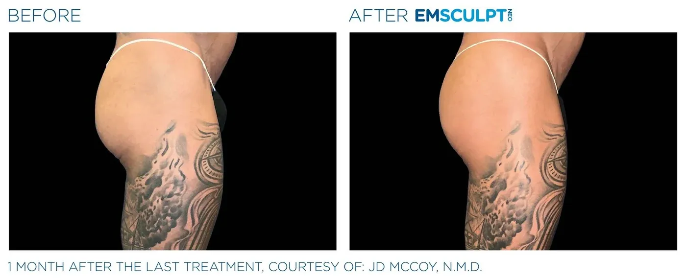Male buttock before and after Emsculpt Neo — courtesy of JD McCoy, N.M.D.