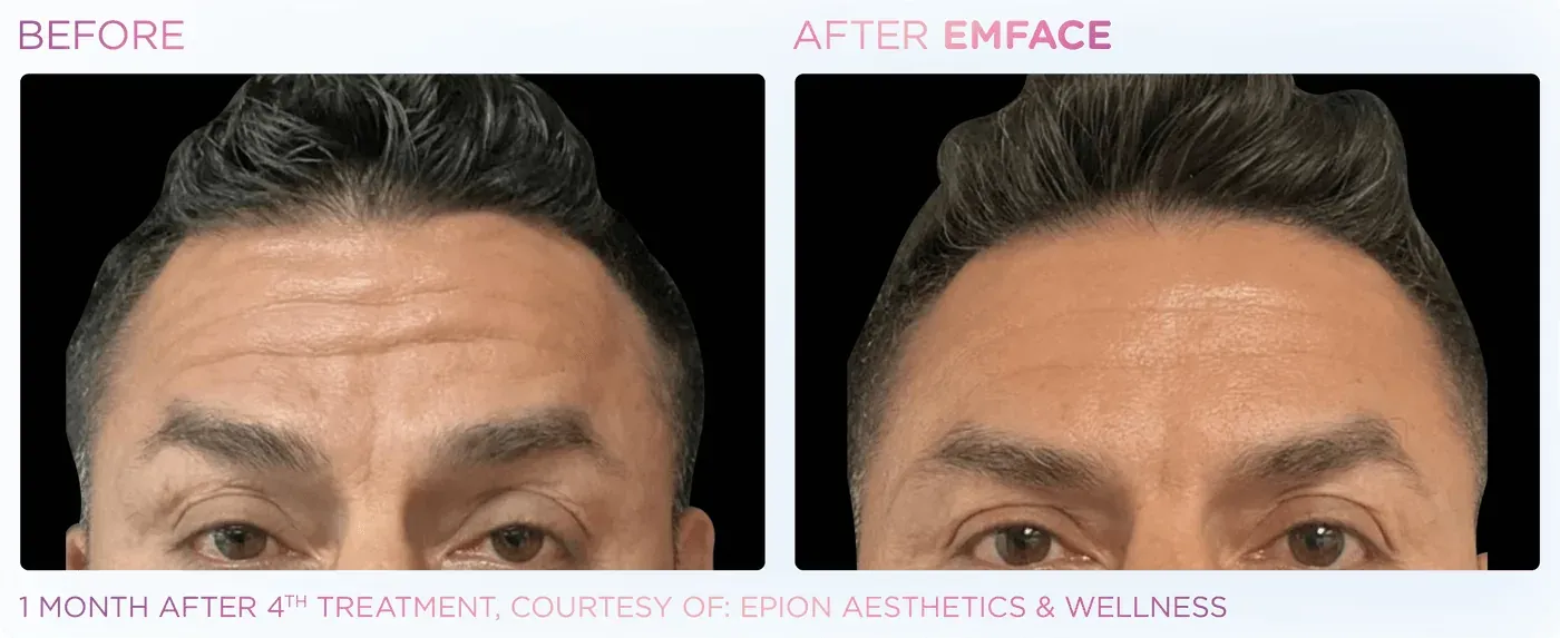 Male forehead before and after EMFACE