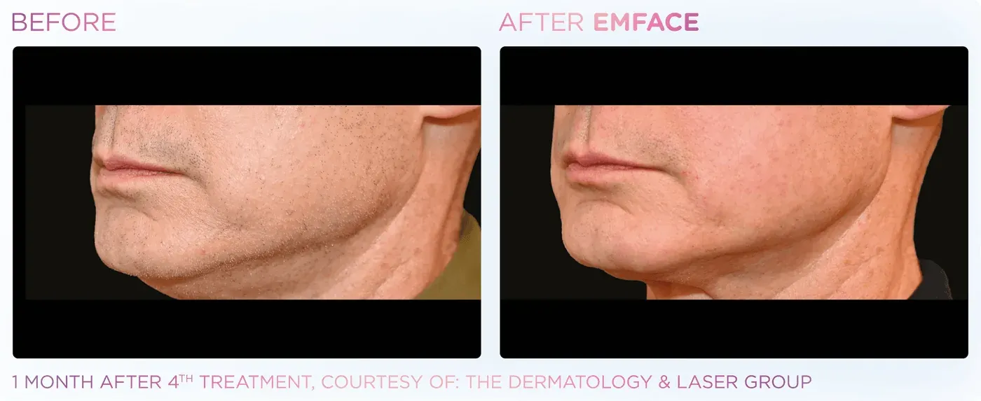 Male jawline before and after EMFACE