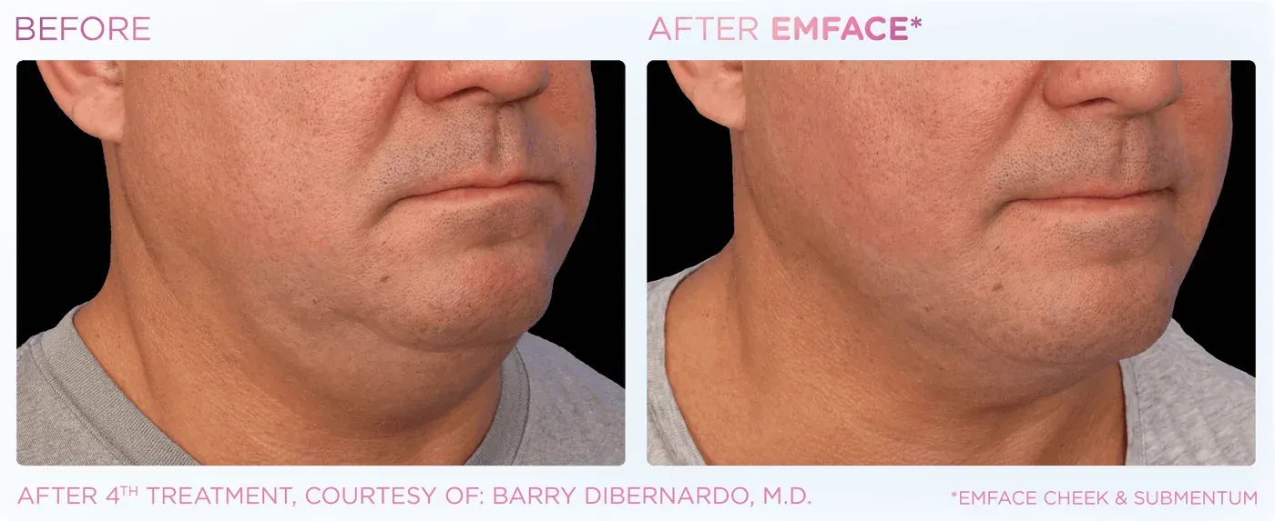 Male submental before and after EMFACE