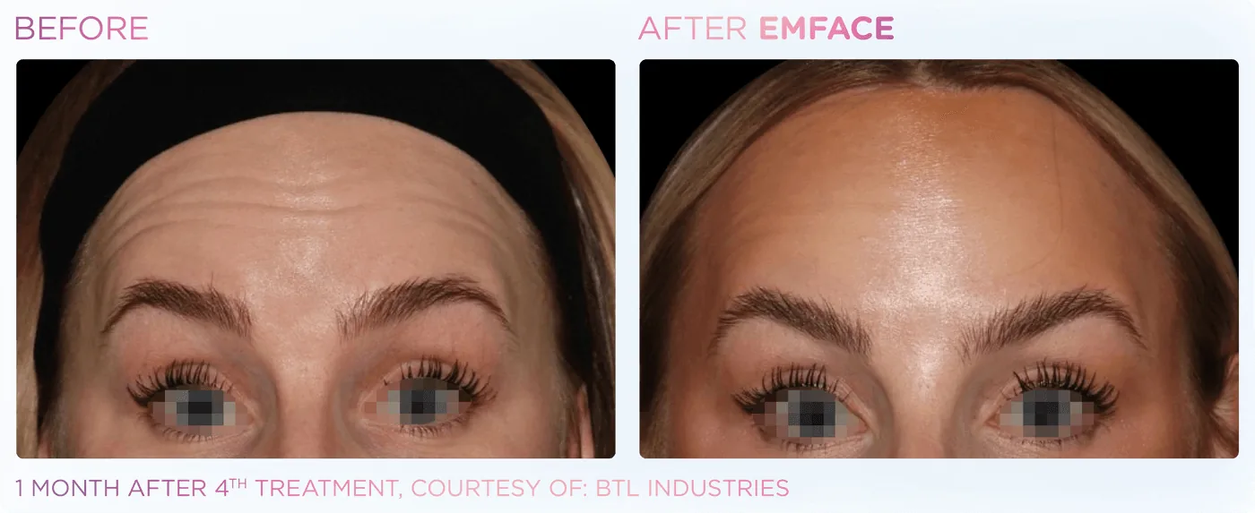 Female forehead before and after EMFACE