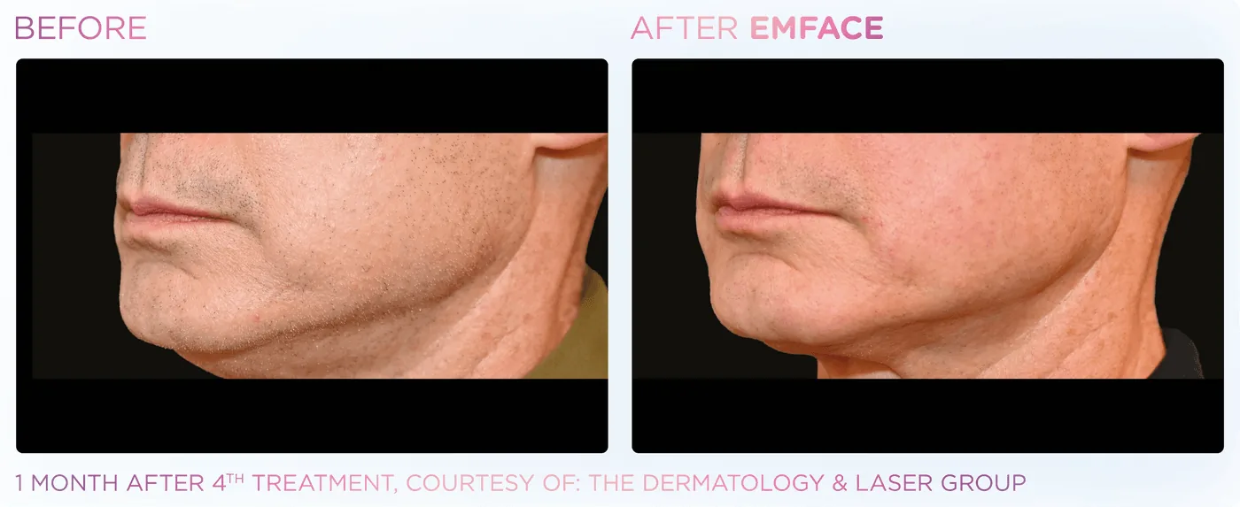Male jawline before and after EMFACE